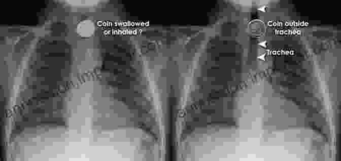 An X Ray Image Reveals Various Ingested Objects, Including A Fork, A Spoon, And A Coin. Swallow: Foreign Bodies Their Ingestion Inspiration And The Curious Doctor Who Extracted Them