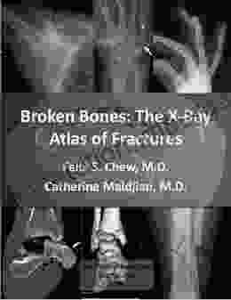 Broken Bones: The X Ray Atlas Of Fractures