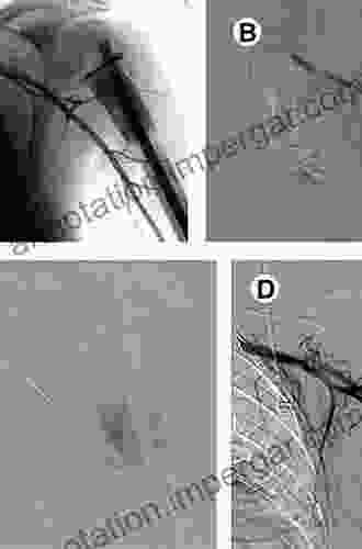 Transcatheter Embolization And Therapy (Techniques In Interventional Radiology)